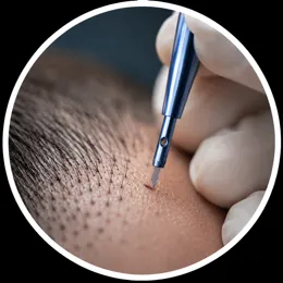 Kopfhaartransplantation